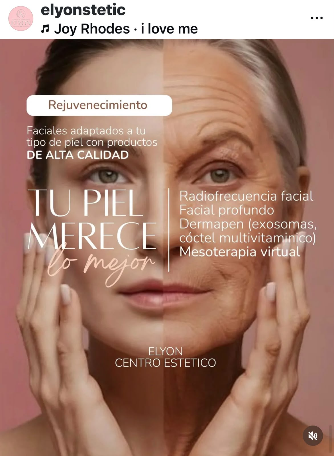 Rejuvenecimiento facial en Elyon Stetic